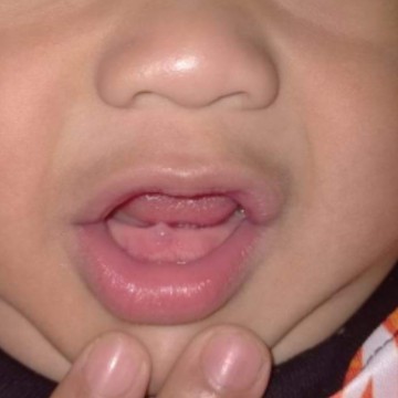 ใช่ฟันน้องจะขึ้นไหมคะ