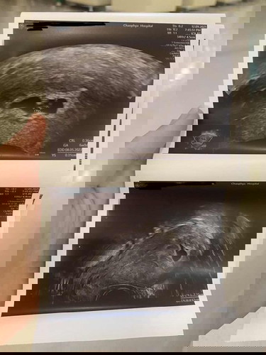 ท้อง 6 สัปดาห์ ยังไม่เจอหัวใจลูก