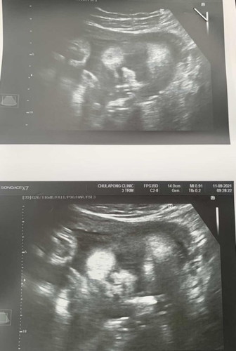 33 week แล้ว ได้ลูกสาว ทีมตุลาคม มีแม่คนไหนยังคิดชื่อเล่นลูกไม่ออกสักที แม่ๆช่วยตั้งชื่อเล่นน่ารกๆให้หน่อย😁😊