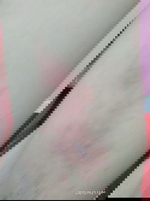 Cacar api/herpes zoster