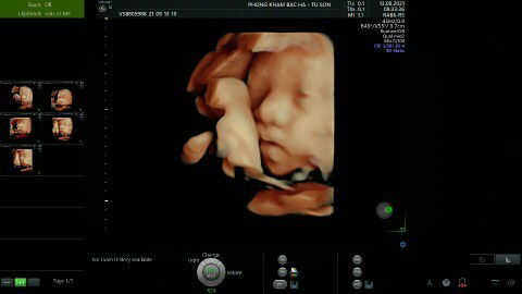 E bầu 32w nay đi siêu âm đc 2kg k biết có to k các mom nhỉ