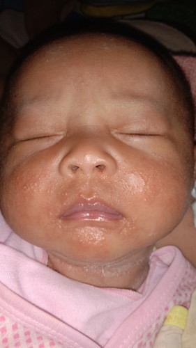 Anak ku umur 24 hari biang keringat di daerah wajah apakh bisa ilang kasian... , obat yg ampuh apa y