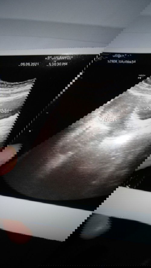 "Tespek 2 garis tapi kata dokter hanya masalah hormonal"