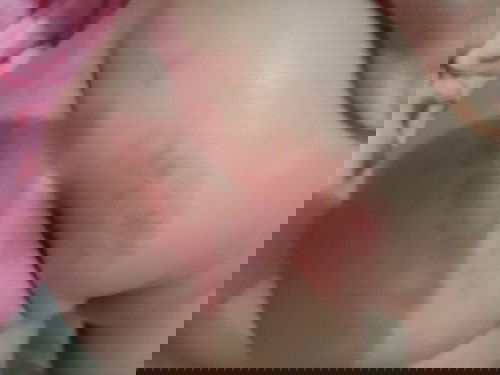 Rashes❗❗❗❗❗❗