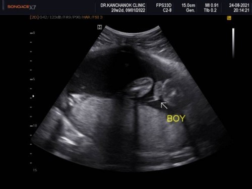 อยากได้ลูกสาว...แต่คุณหมอบอกว่าคุณแม่ได้ลูกชาย