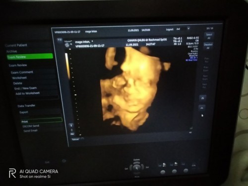 Bunda2, mau tanya nih, apakah wajar usia kehamilan 28minggu (7bulan) posisi bayinya sungsang?😔