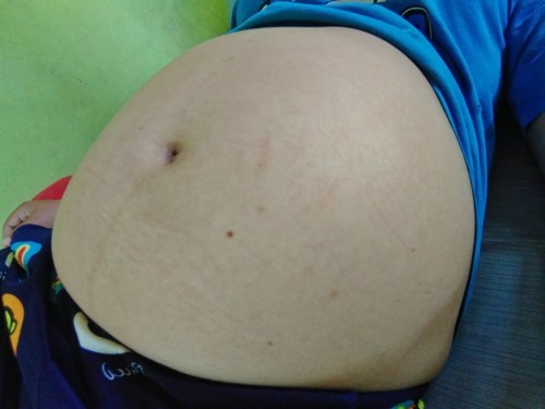 กำหนดคลอดวันที่ 1 กันยา.แต่ยังไม่มีอาการอะไร.นี่ก็เกินมา13วันแล้ว.บางวันก็เจ็บท้องน้อย