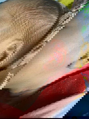 ลูกมีปุ่มใสใสขึ้นที่คอที่หัว