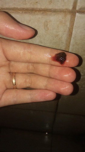 Bunda mohon bantuannya...usia kandunganku udh 8 minggu, hari ini ngflek trus keluar itu, gmnaya?