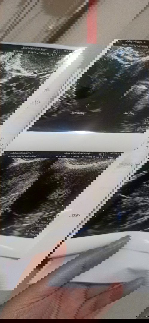 Keguguran UK week 5 #pcos