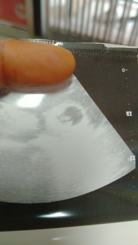 Nk tnye ni twin ? Dokter ckp twin tpi nk confrem kan