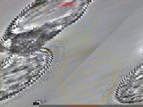 ใส่ตัวอ่อนครั้งที่4 ทำอิ๊กซี่รอบที่2 (สำเร็จแล้วคะ) เด็กหลอดแก้ว