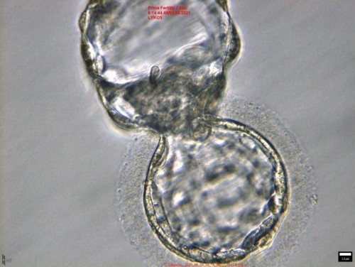 ใส่ตัวอ่อนครั้งที่4 ทำอิ๊กซี่รอบที่2 (สำเร็จแล้วคะ) เด็กหลอดแก้ว