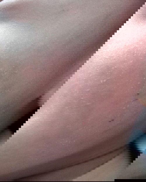 Muka bayi 8 bulan merah2 dan gatal