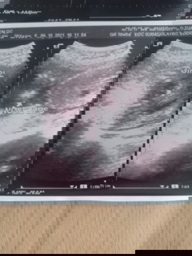19 weeks ultrasound