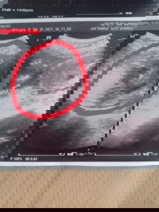 Gender Disappointment is Real