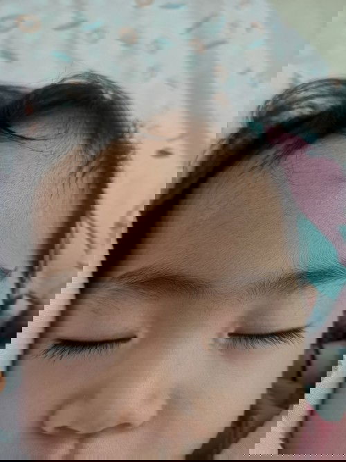 หัวโขกกันกับลูก หน้าผากเขียวไม่หาย