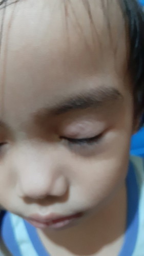 Help po ano po kaya itong tumubo sa pilik mata ng anak ko at paano kaya mawala.. tagal na po kasi e