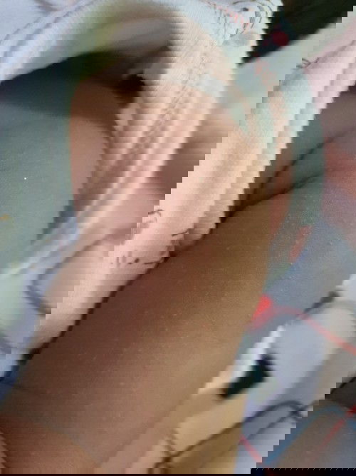 Bruntusan Bayi 1 Bulan