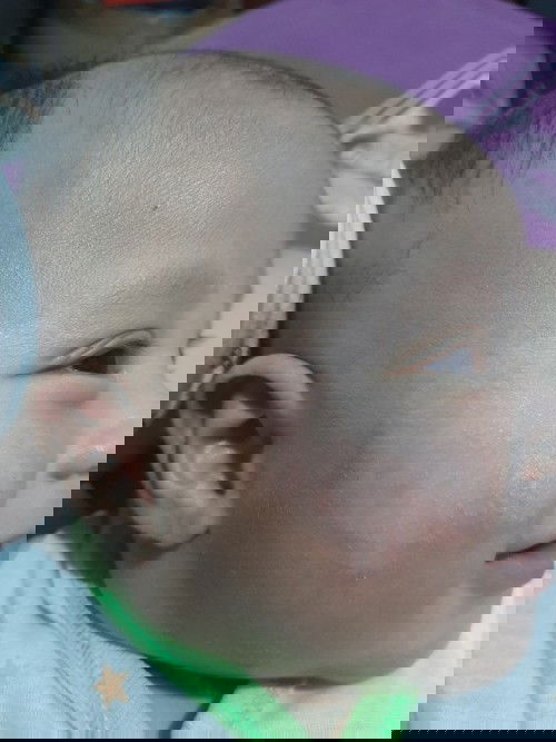 Alergi dermatitis atopik