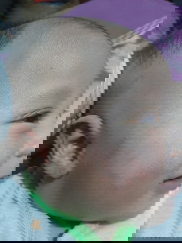 Alergi dermatitis atopik