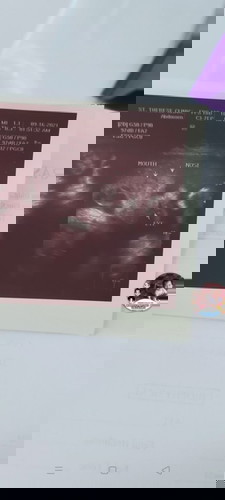 Worried Po Kasi ako ,nakanganga lang Po ba si baby o may problem sa bibig nya . Diko na ask sa ob ..