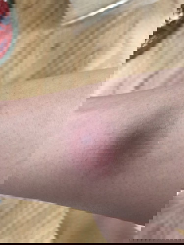 Pigsa o kagat ng insect