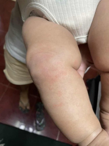 Baby Skin Rash