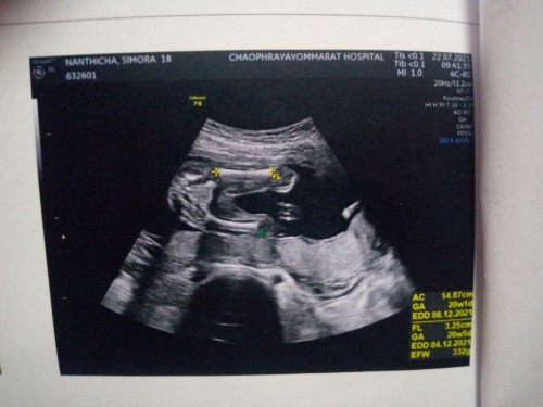 ช่วยดูหน่อยค่ะว่าผญ หรือผช  ตอน20วีคค่ะ ปัจจุบัน28วีคค่ะ👶❤️🙏