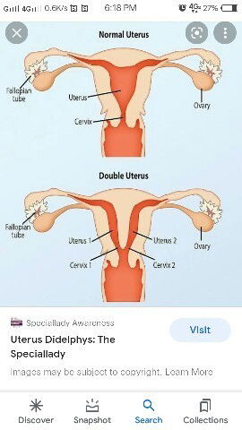 Sino po dito ang mayroong Didelphys Uterus?