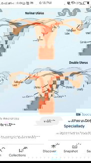 Sino po dito ang mayroong Didelphys Uterus?