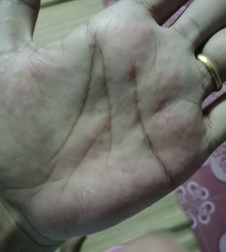 แพ้น้ำยาล้างจาน มือกลายเป็นแบบนี้ จะมีผลอะไรกับลูกไหม