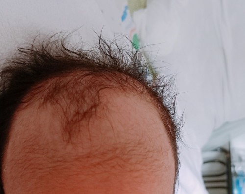 Hello ,na experience nyo din ba ito?.27days na si baby and naglalagas yung buhok nya.
Normal ba ito?