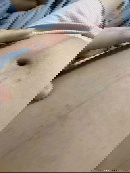 เป็นสิวผดที่ท้อง