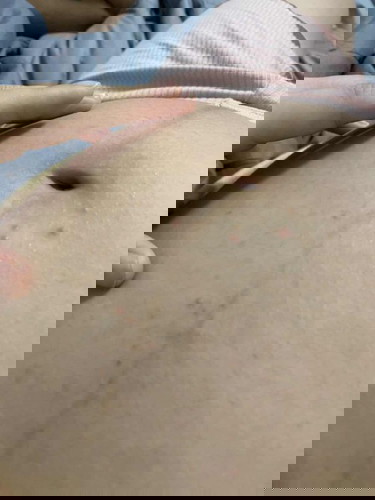 เป็นสิวผดที่ท้อง