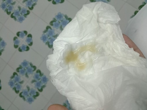 37+4 มีมูกแบบนี้ออกมาควรไปหาหมอไหมค่ะ