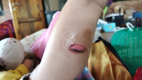 ขอคำแนะนำในการรักษาแผลหน่อยค่ะ