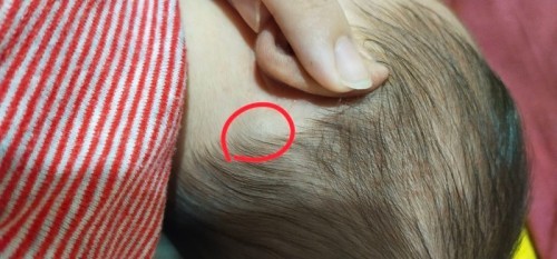 May pea size bump po si baby sa back ng tenga nya, accdg sa pedia friend kulani daw po ito.