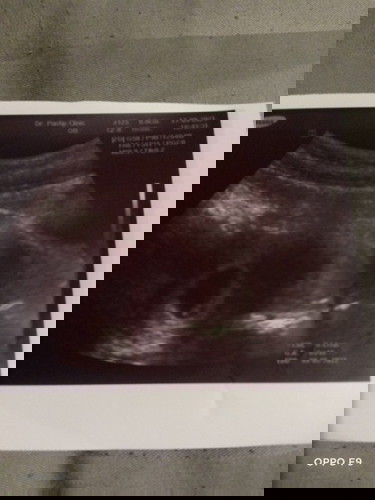 หลังแท้งลูก