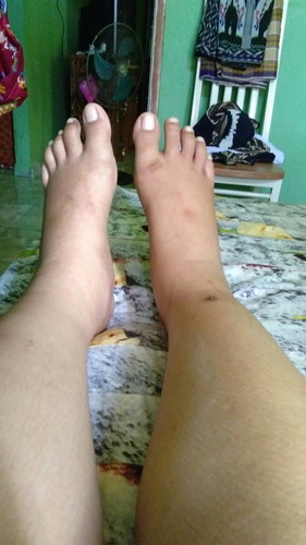 Kaki bengkak