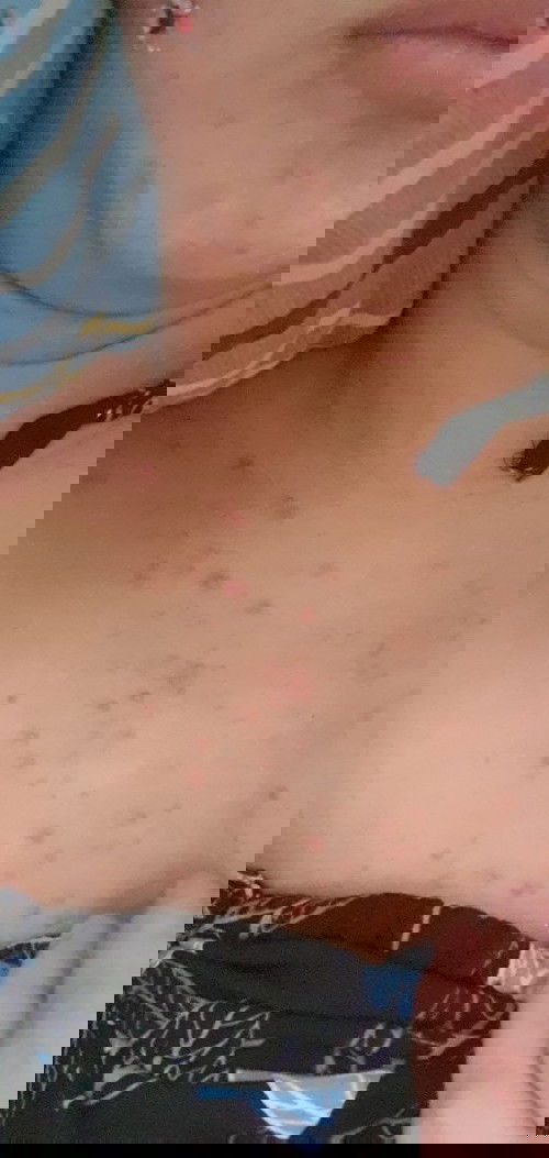 Apakah ada bumil yang hamil besar banyak jerawat kecil di bawah leher/atas payudara? HAMIL 30 minggu