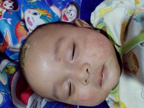 Merah di pipi bayi