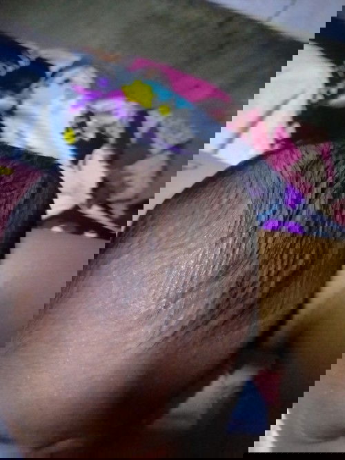 Bukol na malambot sa ulo ni Baby