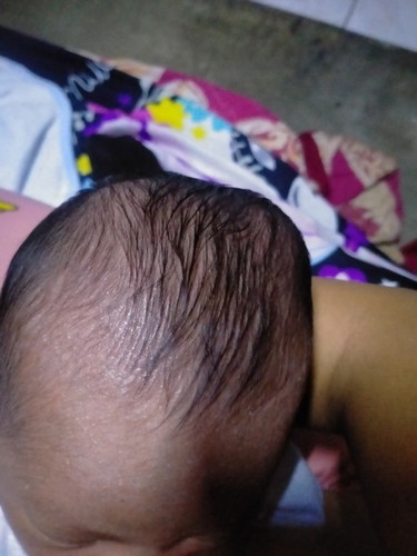 Bukol na malambot sa ulo ni Baby