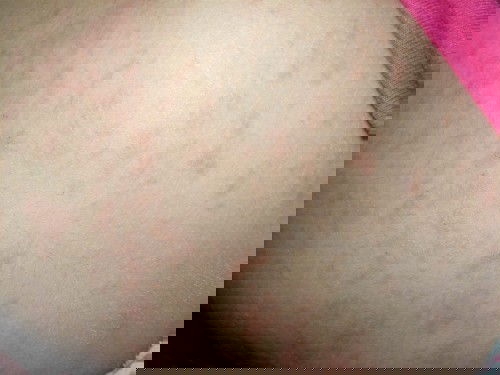 Ruam di ketiak dan di seluruh badan