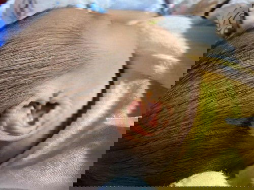 มีติ่งข้างหูขวา