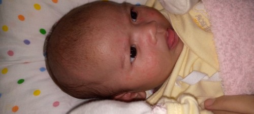 ลูกมีผดผื่น