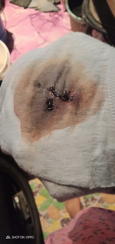 Blood stain