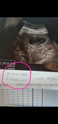 Kenangan semalam scan baby..