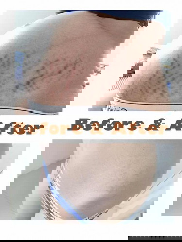 ปัญหาอันดับ 1 ของ แม่ๆ
ท้องแตกลาย